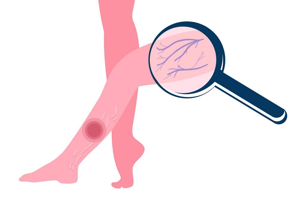 Jambes lourdes : Causes et solutions naturelles - Laboratoire de ...