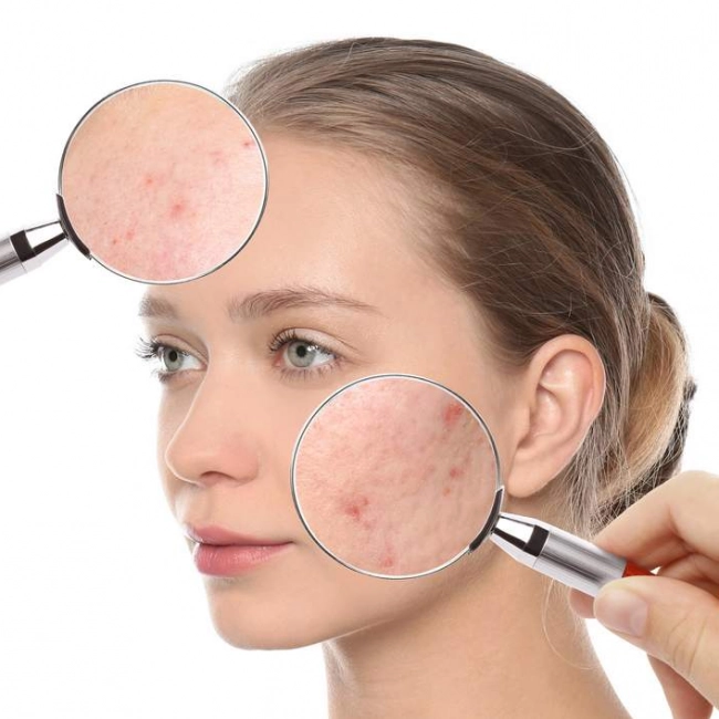 Boutons sur le visage : signification ? Boutons sur le visage : signification ?